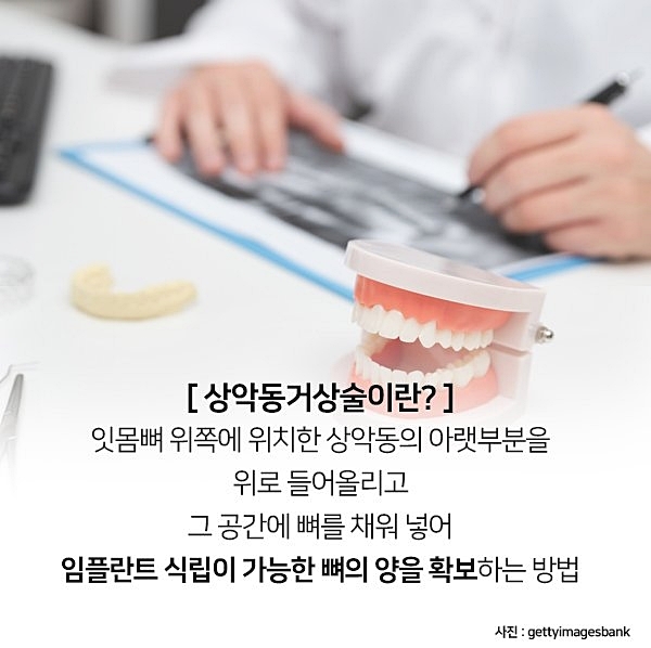 잇몸뼈가 부족해 임플란트 수술 어렵다면? 관련 이미지 8