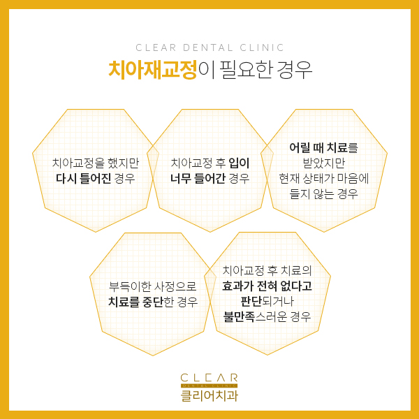 더이상의 실패는 그만 ! 강남클리어치과 재교정GO! 관련 이미지 3