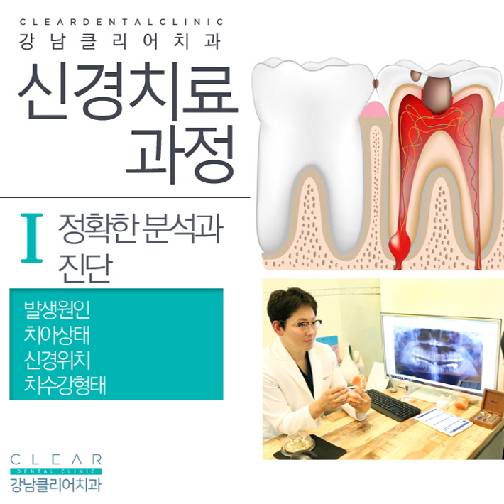 치아 신경치료 가볍고 쉽게 생각해선 안된다 관련 이미지 4