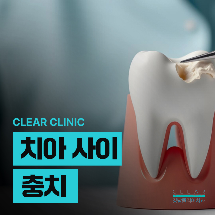 치아 사이 충치 조기에 발견해야 관련 이미지 1