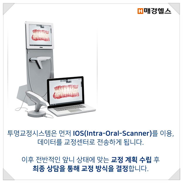 클리어 치과 상식 - 앞니 부분교정 전 꿀팁! 관련 이미지 10