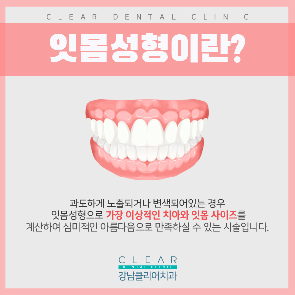 자신감 있는 스마일라인 잇몸성형 관련 이미지 2