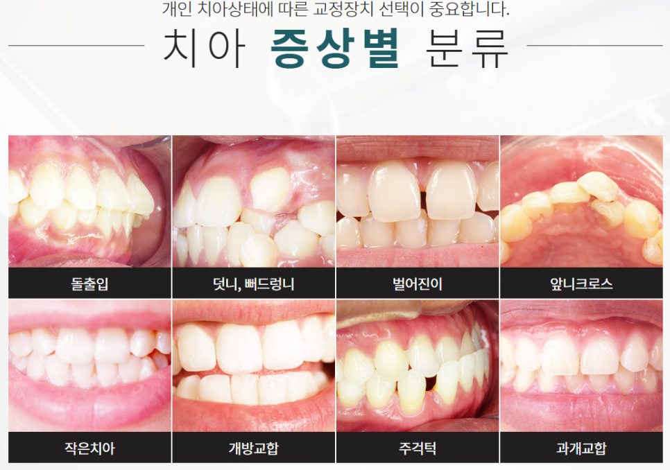 반포동치아교정 변형 정도에 따라 관련 이미지 4