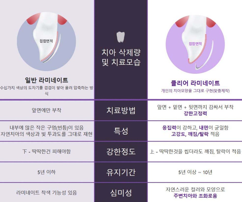 클리어치과에서 클리어한 라미네이트를 관련 이미지 3