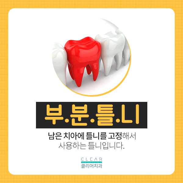 제2의 치아 틀니, 틀니가 무엇인가요? 관련 이미지 4