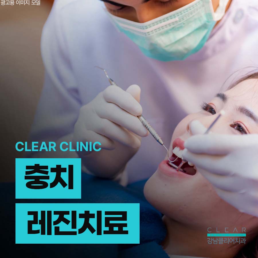 충치 레진치료 치아 갈색점 검은점이 보이면 서둘러야 관련 이미지 1
