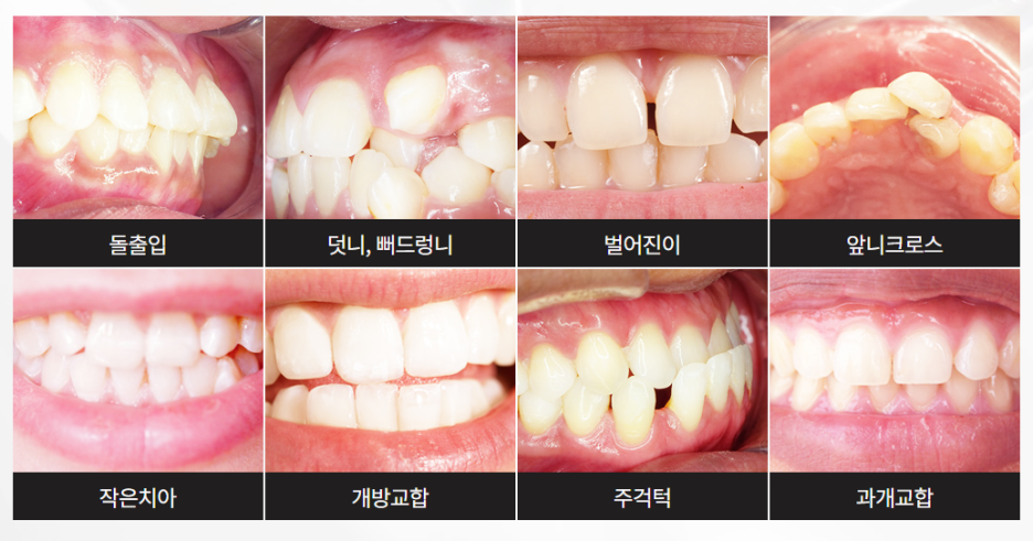 서초동교정치과 기능과 심미성 모두 놓치지 않도록 관련 이미지 2