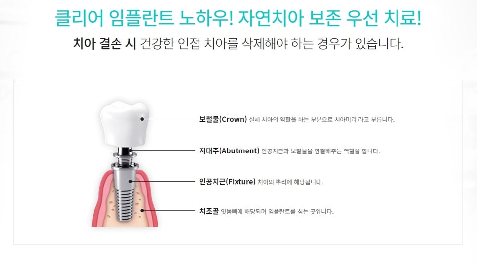 클리어치과 임플란트 비용 후기 찾는다면 관련 이미지 3