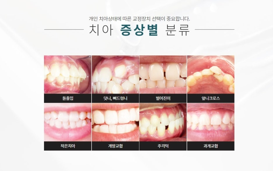 서울치아교정 치과추천 면밀 꼼꼼하게 찾고 관련 이미지 5