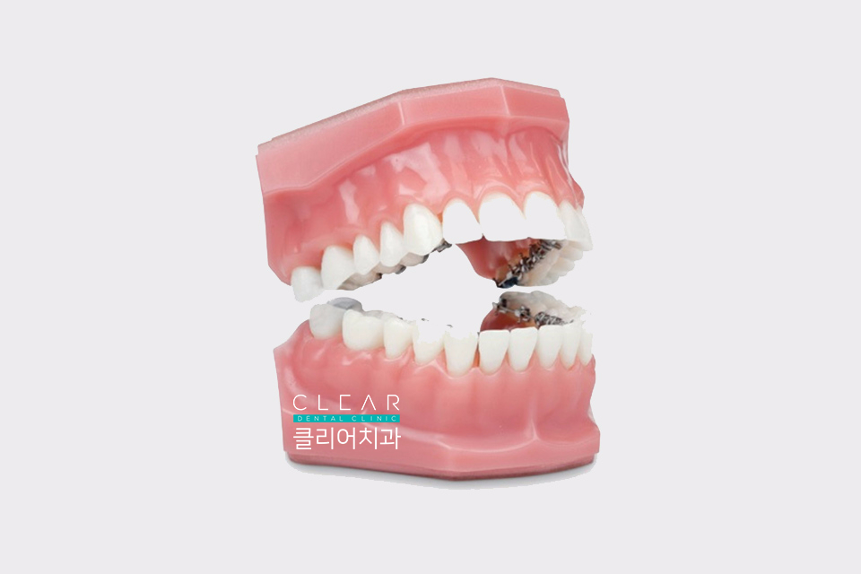 치아 교정 종류 및 교정 방법 관련 이미지 4