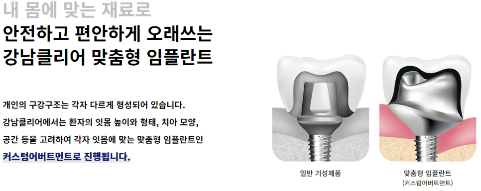 강남임플란트비용 가격 합리적으로! 관련 이미지 3