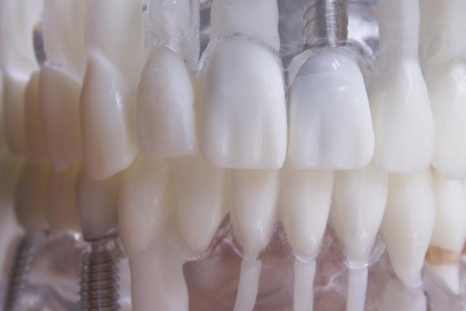 당일 임플란트 조건 무엇이 필요할까 관련 이미지 20