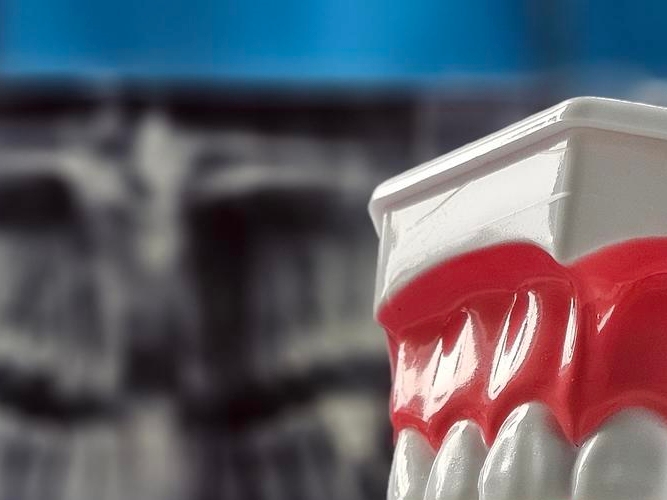 신경치료 후 통증이 생기는 이유 관련 이미지 16