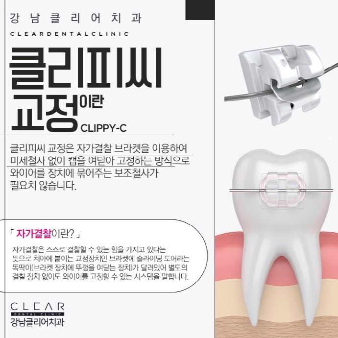 강남역 클리피씨교정 심미성과 기능성 1석2조 효과 관련 이미지 3