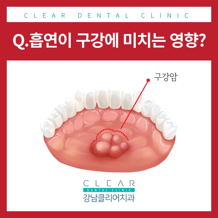 구강의 건강과 흡연 관련 이미지 4