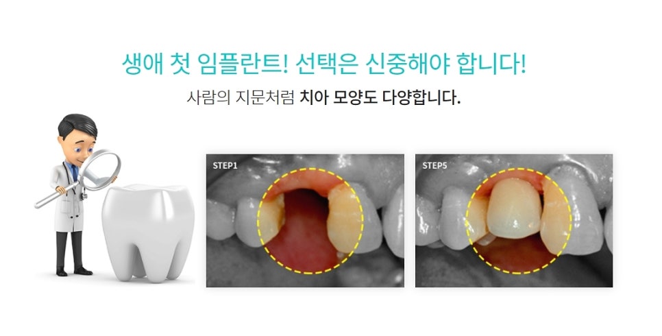강남임플란트 찾아보고 결정하자 관련 이미지 8