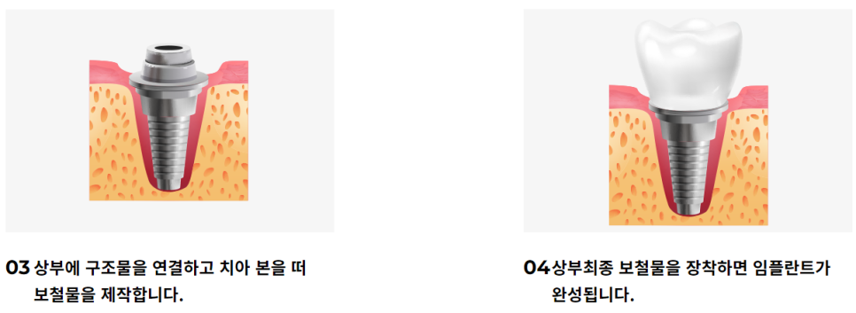 논현동임플란트치과 오래 사용할 수 있도록 관련 이미지 6