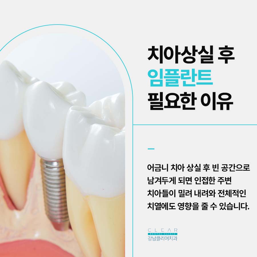 어금니임플란트치료 시 고려해야하는 점 관련 이미지 2