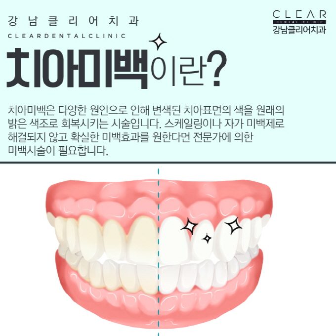 강남치아미백 이벤트 가격 효과 모두 만족 관련 이미지 2