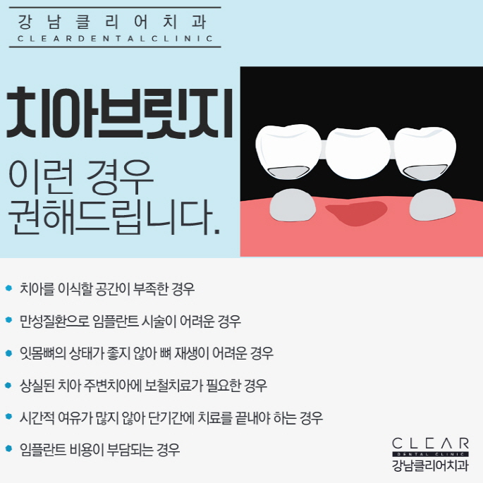 치아브릿지 강남치아브릿지도 이제 맞춤형으로 관련 이미지 3