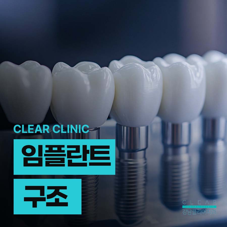 임플란트 구조 수명은 어느정도? 관련 이미지 1