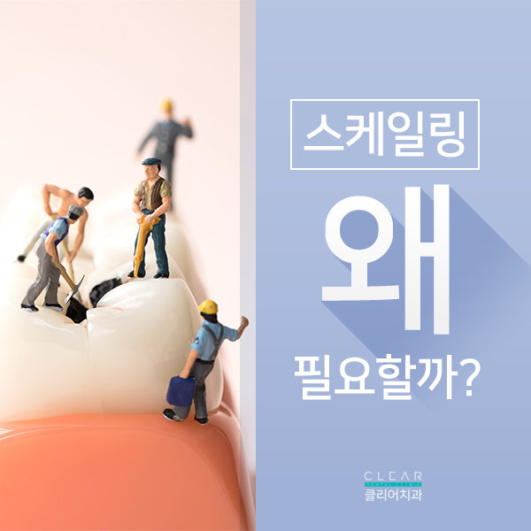 자연치아를 소중히 하기 위한, 스케일링 관련 이미지 2