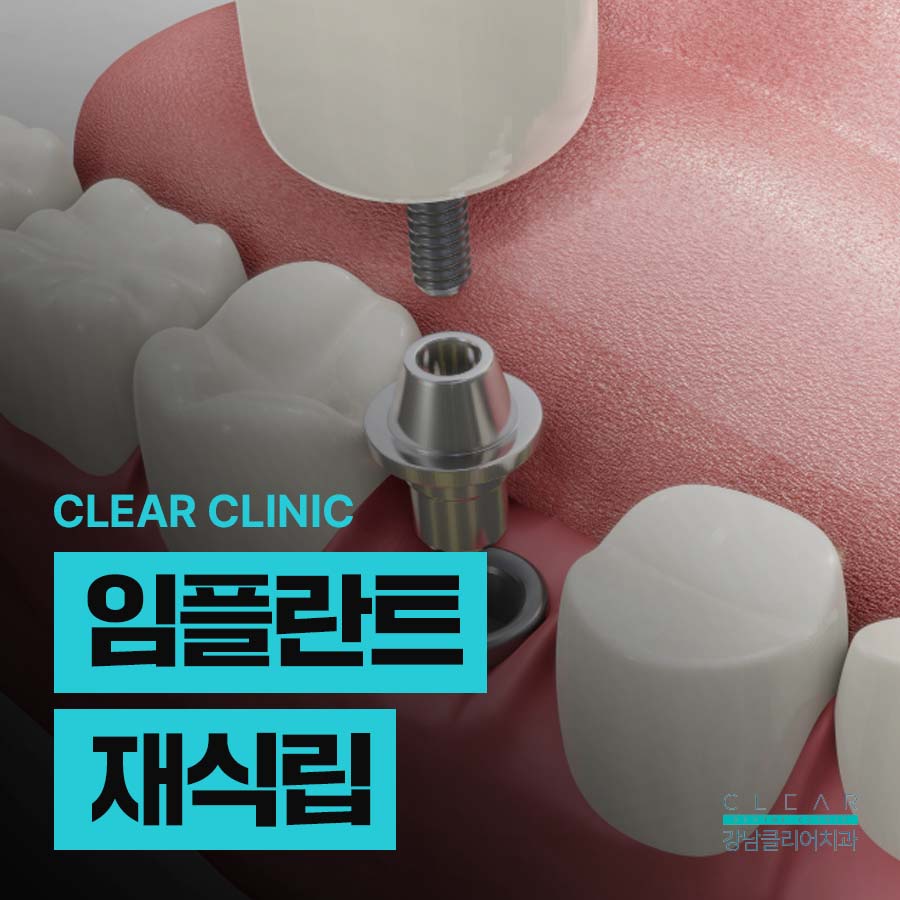 임플란트 재식립 필요한 경우 주의사항은 관련 이미지 1