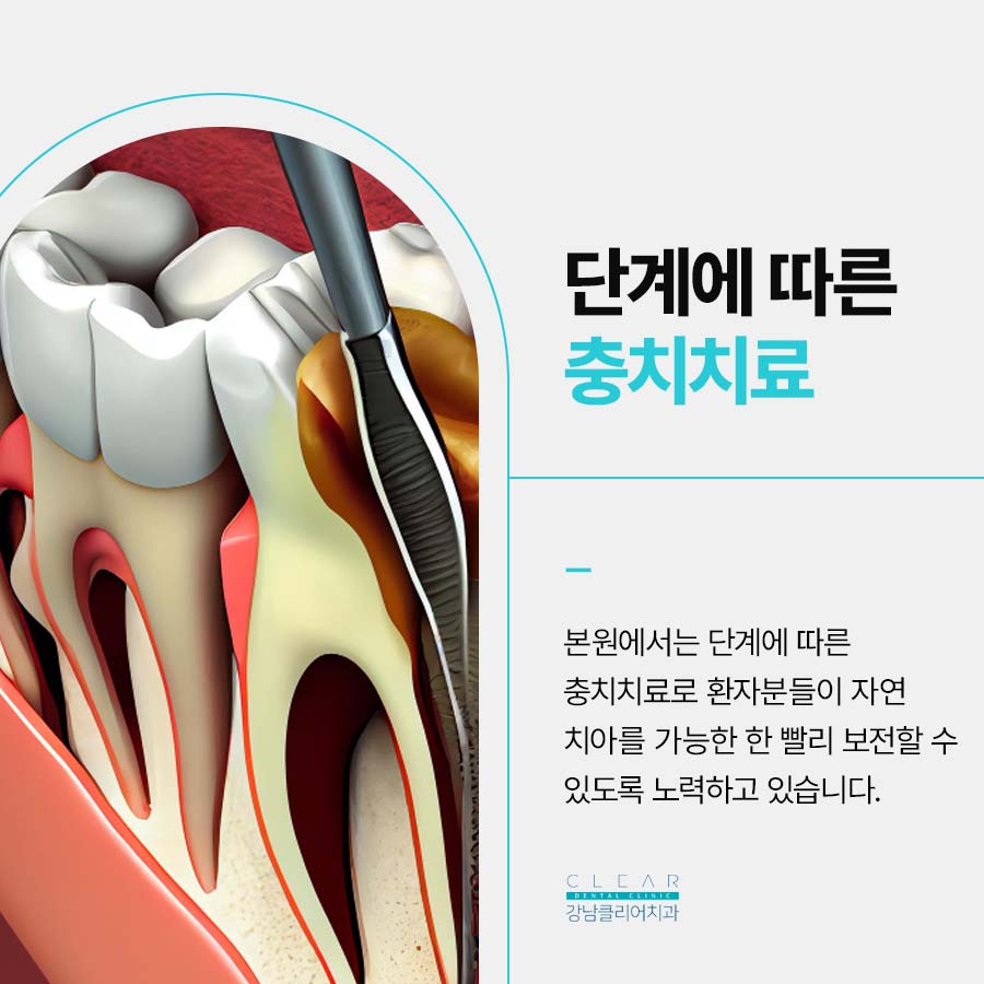 강남역 치과 잘하는곳 충치부터 임플란트까지 관련 이미지 2