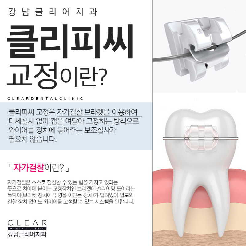 강남역클리피씨교정 결과, 심미성, 기간단축 모두 가능 관련 이미지 3