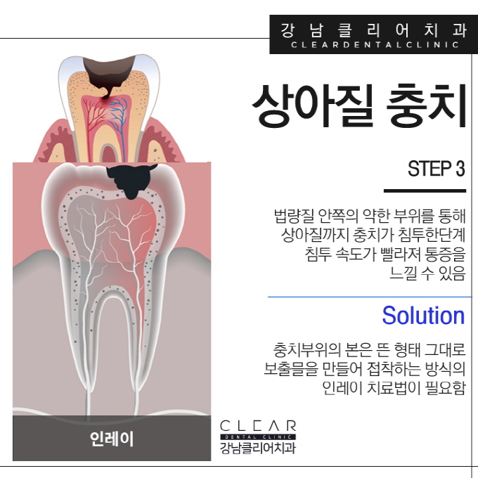 강남역충치치료 단계별 달리지는 치료방법 관련 이미지 7