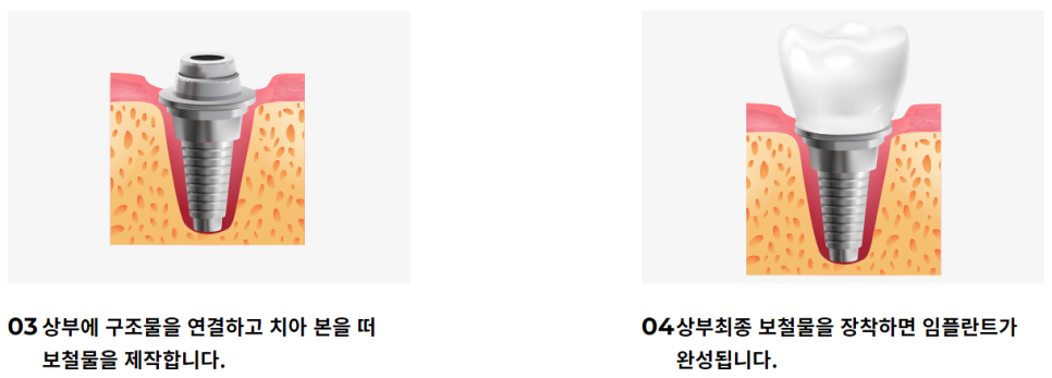역삼동임플란트 수준 높은 곳을 찾는다면? 관련 이미지 7