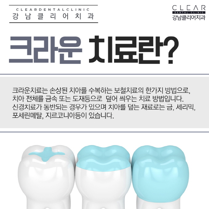 치아보철치료 치아보철종류 융시크 체험기 관련 이미지 3