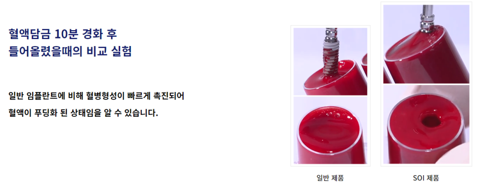 치과 임플란트 기간 얼마나 걸릴까? 관련 이미지 8