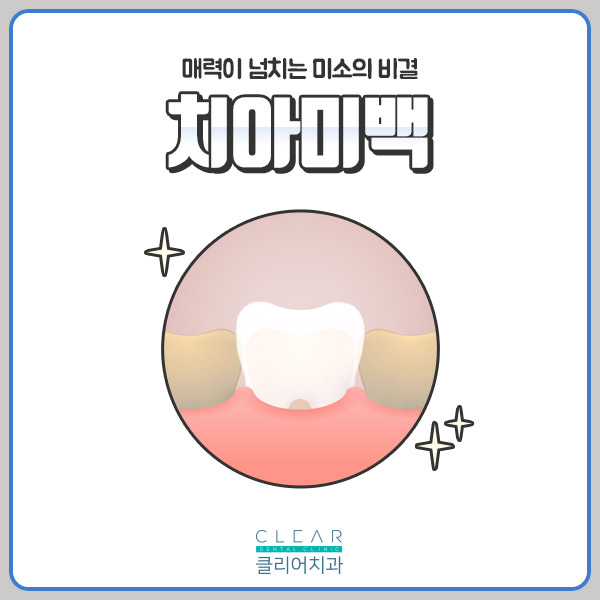반짝반짝 눈이 부시는 클리어 치아미백 관련 이미지 1