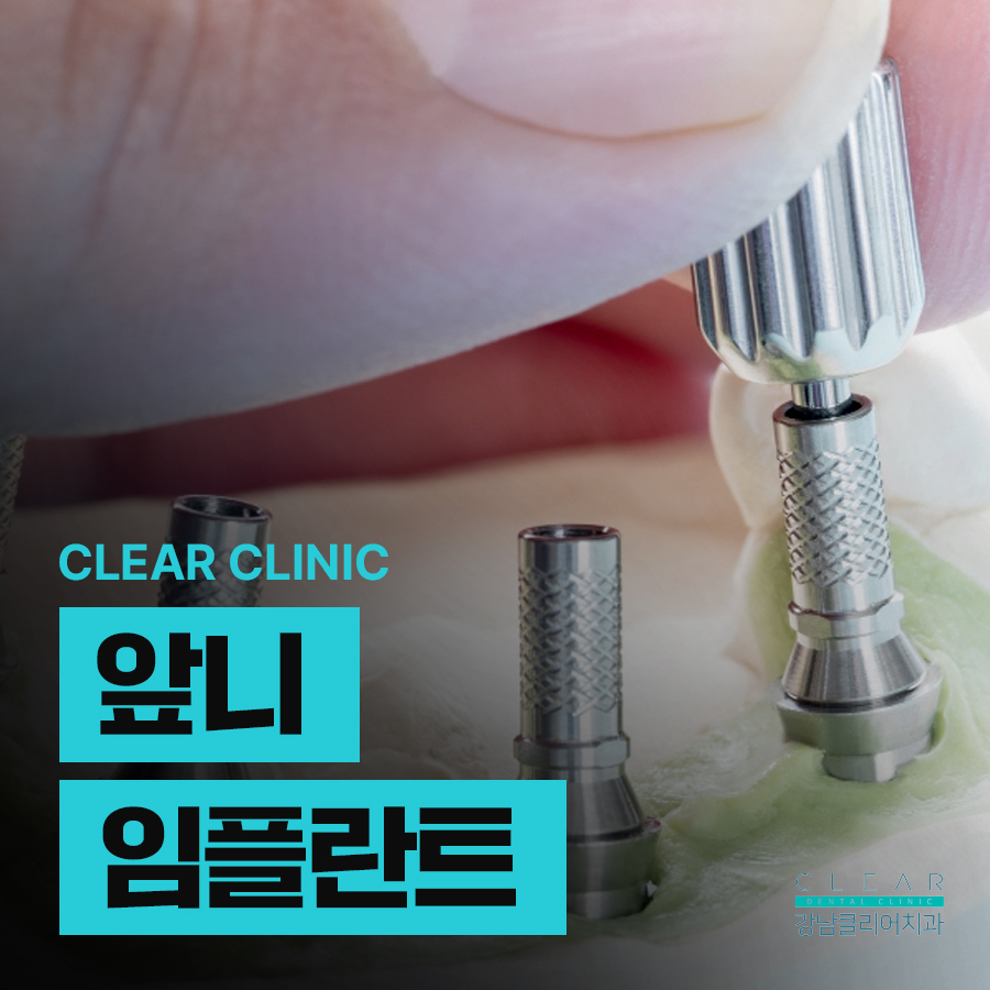 앞니 임플란트 치료기간 얼마나 걸릴까 관련 이미지 1