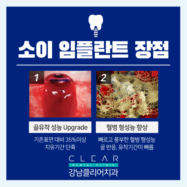 강남임플란트잘하는치과 SOI(소이) 임플란트 첫 도입 이벤트 관련 이미지 3