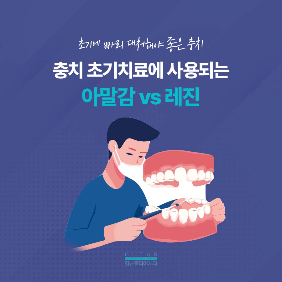 충치치료 레진 아말감 차이 비교점 관련 이미지 2