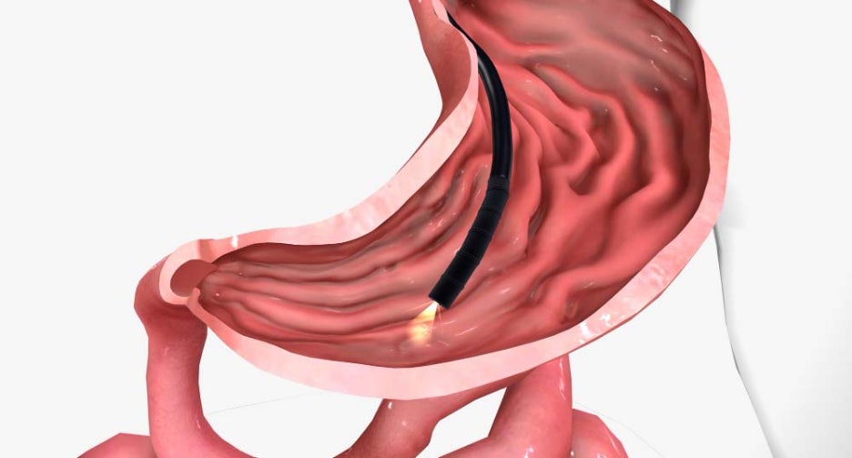 위내시경 금식시간 전날 음식 피해야 할 것은 관련 이미지 2