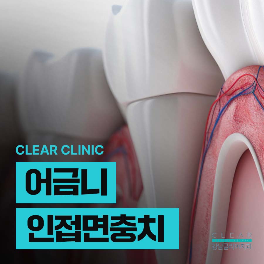 어금니 인접면충치 인레이 치료 적합한 이유 관련 이미지 1