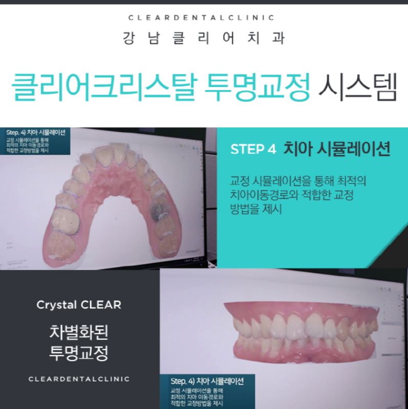 강남역투명교정 자연스러운미소를 가져보세요! 관련 이미지 8