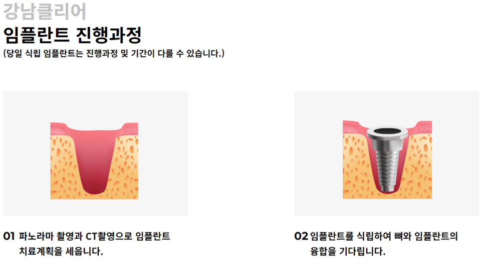 강남임플란트잘하는치과 내 구강 구조에 맞게! 관련 이미지 5