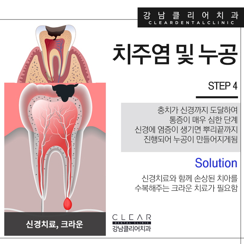 강남역충치치료 나에 충치 단계에 맞게 관련 이미지 7