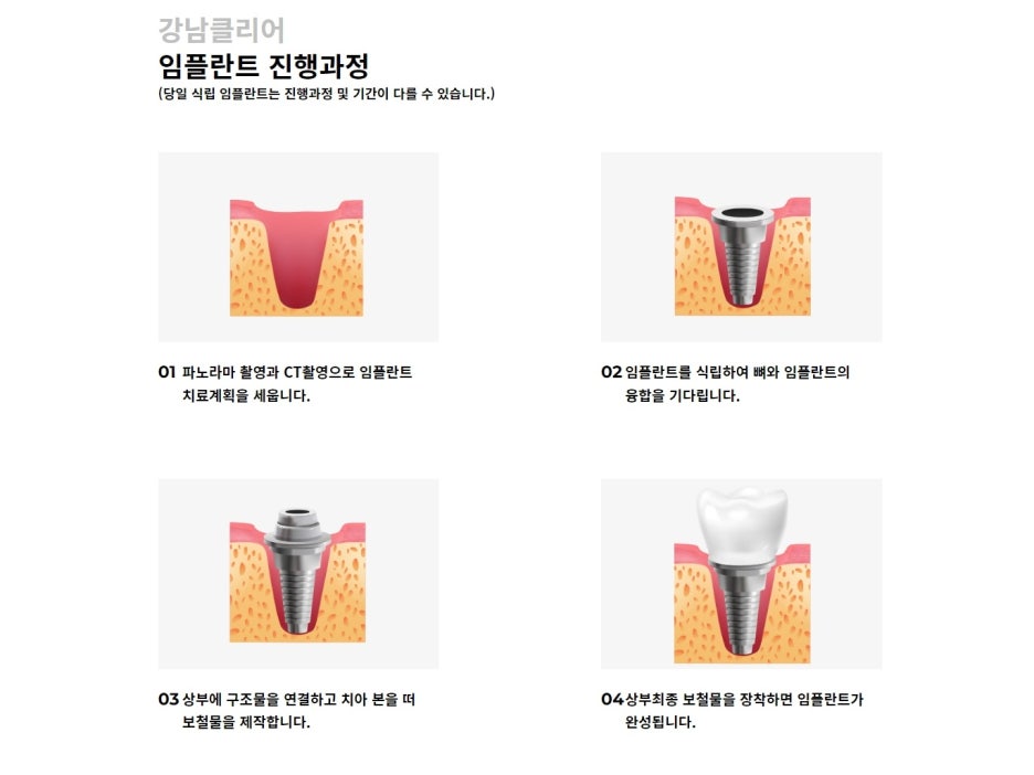 강남구 임플란트치과 후기 괜찮은 곳은? 관련 이미지 7