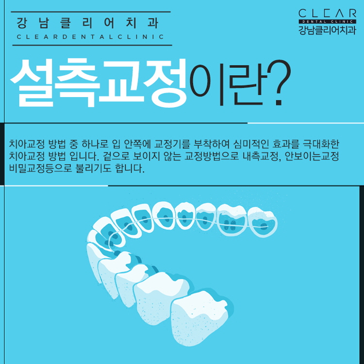 치아설측교정 안보이는 치아교정 맞춤형도 가능 관련 이미지 2