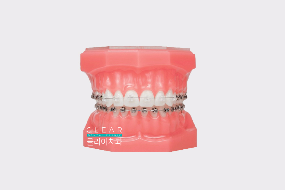 치아 교정 종류 및 교정 방법 관련 이미지 5