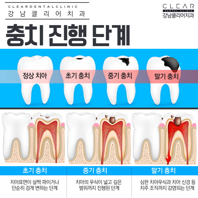 강남충치치료 레진, 인레이, 크라운 단계별 충치치료 관련 이미지 2