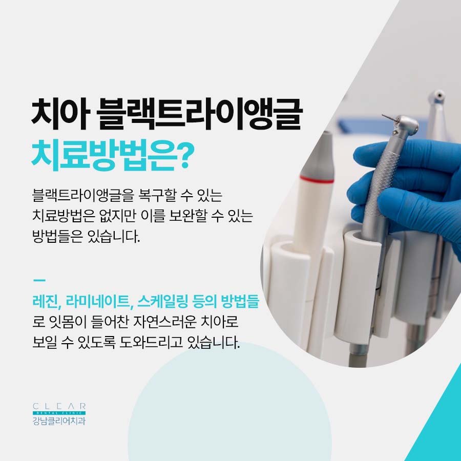 치아 블랙트라이앵글 원인 치료방법은? 관련 이미지 4
