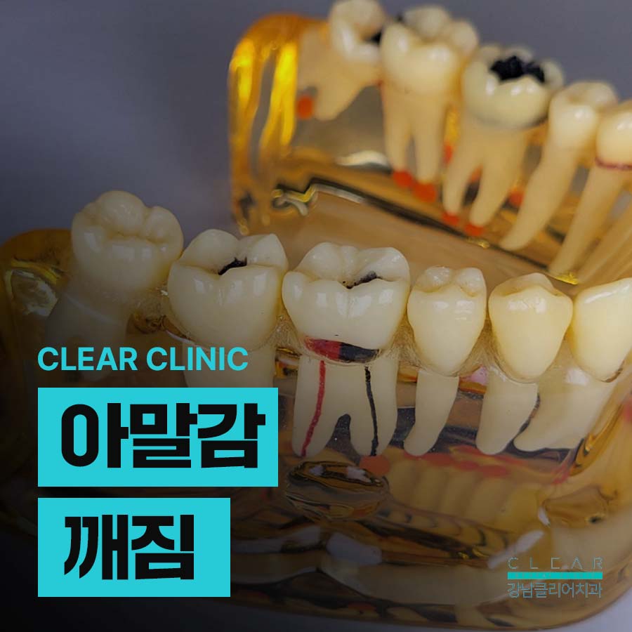 아말감 깨짐 떨어짐 대처방법 어떻게? 관련 이미지 1