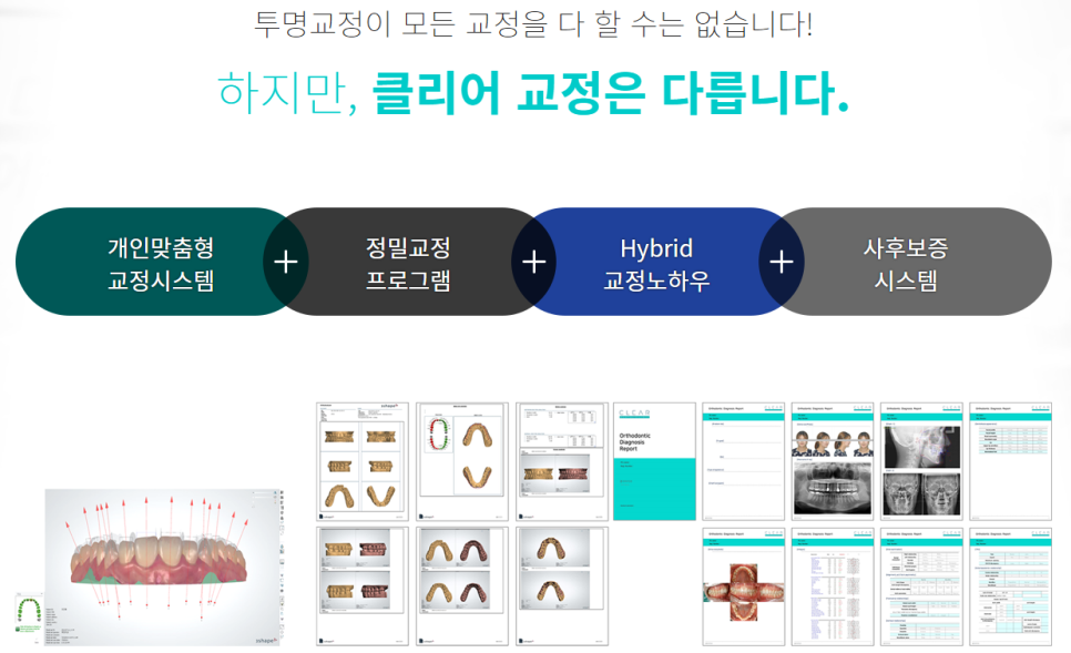 서초동치아교정잘하는곳 심미성까지 생각한다면 관련 이미지 6