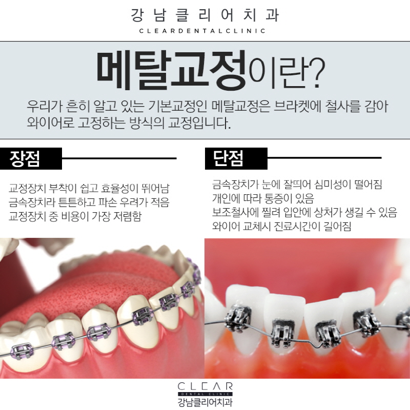 강남 클리피씨교정 잘하는곳 알려드려요. 관련 이미지 2